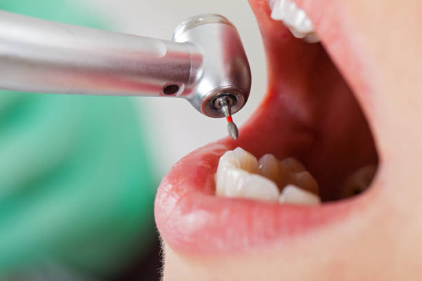 Best Emergency Dental Care for Abscessed Tooth in Pineville, NC